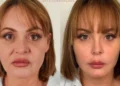 Gaby Spanic, de Usurpadora, surge irreconhecível após harmonização facial
